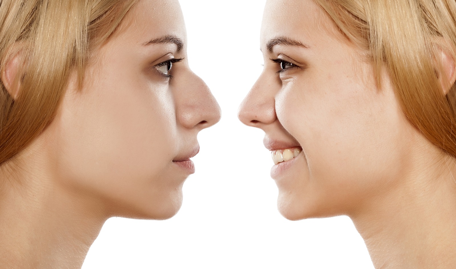Rhinoplastie : ce qu’il faut savoir avant de franchir le pas
