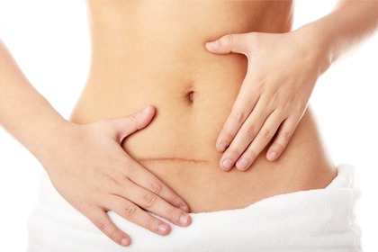 Chirurgie esthétique: la reprise de cicatrice