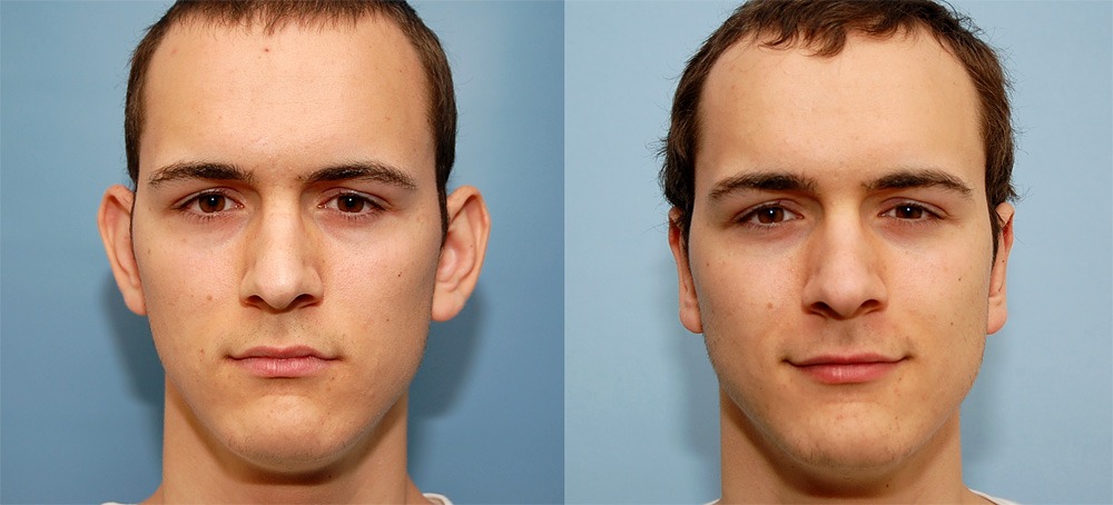 Otoplastie : la chirurgie des oreilles décollées expliquée