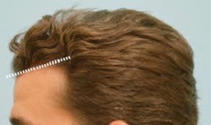 Les différents types d’implants capillaires